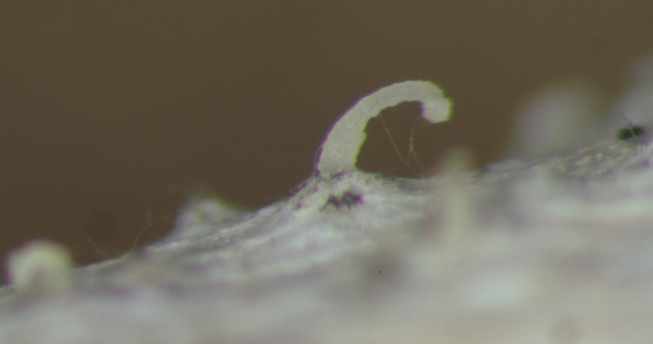 Enfermedad CAM374