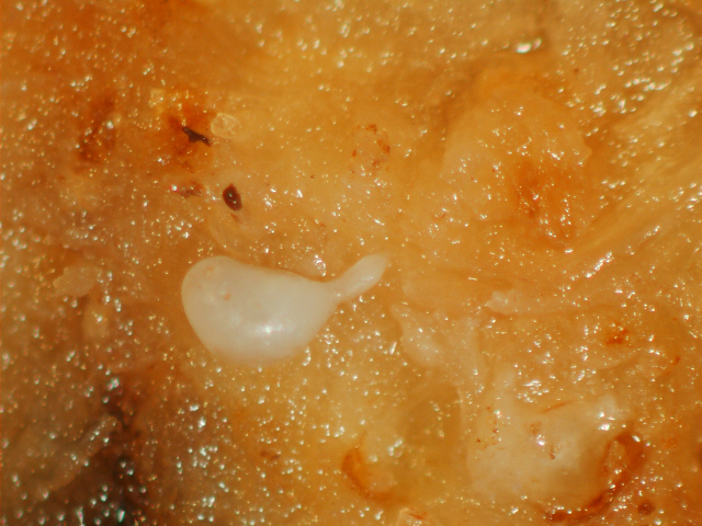 Enfermedad RSM332
